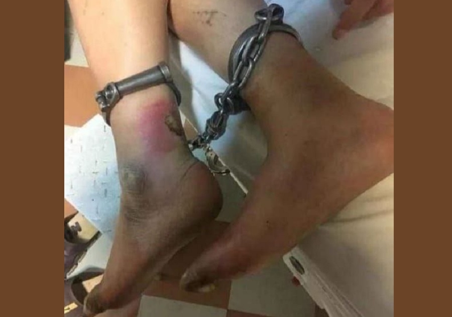 چهار انگشت دیگر پای «اکبر لکستانی» زندانی سیاسی سابق آذربایجانی قطع شد